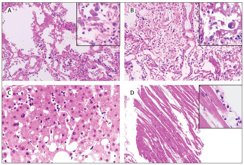 covid-19 患者死后活检显微镜下所见,a-d 分别为右肺,左肺,肝,心肌
